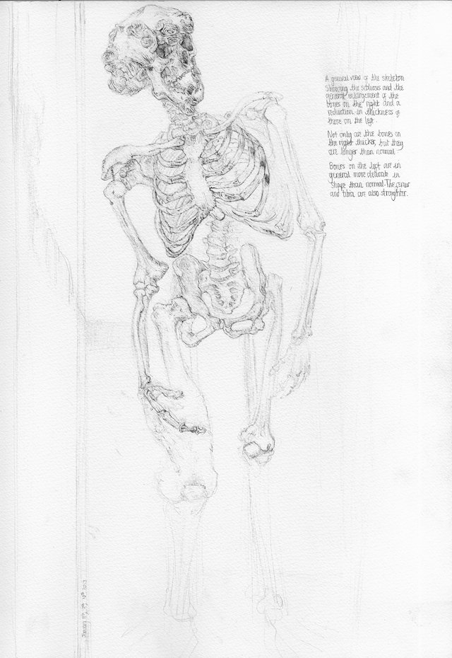 Merrick Skeleton Joseph Merrick Skeleton Display